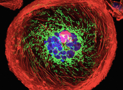 Νέο «εργαλείο» μικροσκοπίας παρακολουθεί λεπτομερώς το πώς εξαπλώνεται ο καρκίνος του μαστού