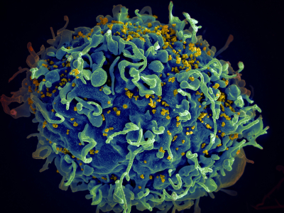 AIDS: Ερευνητές εξάλειψαν επιτυχώς τον ιό HIV από μολυσμένα κύτταρα