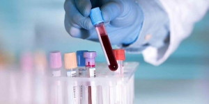 Ελπίδες για το θαύμα: Πληροφορίες για τεστ αίματος που ανιχνεύει τον καρκίνο πέντε χρόνια πριν την εμφάνισή του
