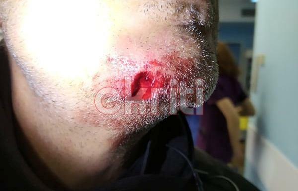 Κρήτη: Αντέδρασε στον έλεγχο και δάγκωσε αστυνομικό στο πρόσωπο