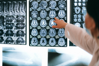 Βιοδείκτες «εγκεφαλικής ηλικίας» προβλέπουν με ακρίβεια την έκβαση του εγκεφαλικού