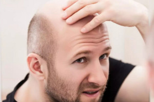 Τριχόπτωση στον άνδρα: Τι δεν συμβάλλει στην απώλεια μαλλιών
