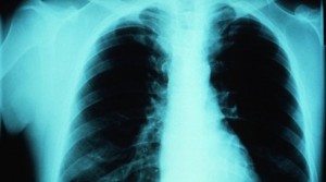 Το άσθμα επιβαρύνει σημαντικά την προσωπική και επαγγελματική ζωή των ασθενών