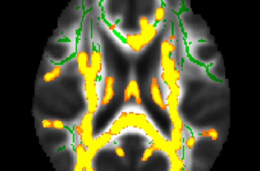Αυξημένη νευροφλεγμονή (με κίτρινο χρώμα) στη λευκή ουσία του εγκεφάλου