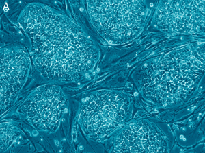 Γιατί οι «επαναστατικές» θεραπείες βλαστοκυττάρων και γονιδίων δεν είναι αθώες;