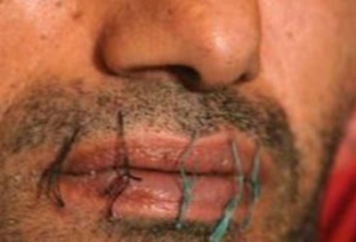Λάρισα: 31χρονος κρατούμενος «έραψε» το στόμα του, ήθελε να αλλάξει φυλακή