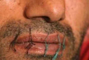 Λάρισα: 31χρονος κρατούμενος «έραψε» το στόμα του, ήθελε να αλλάξει φυλακή