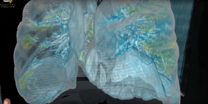 Βίντεο 3D αποκαλύπτει τις βλάβες που προκαλεί ο κορονοϊός στους πνεύμονες