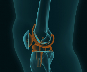 Τι ισχύει για την αρθροπλαστική γόνατος και ισχίου