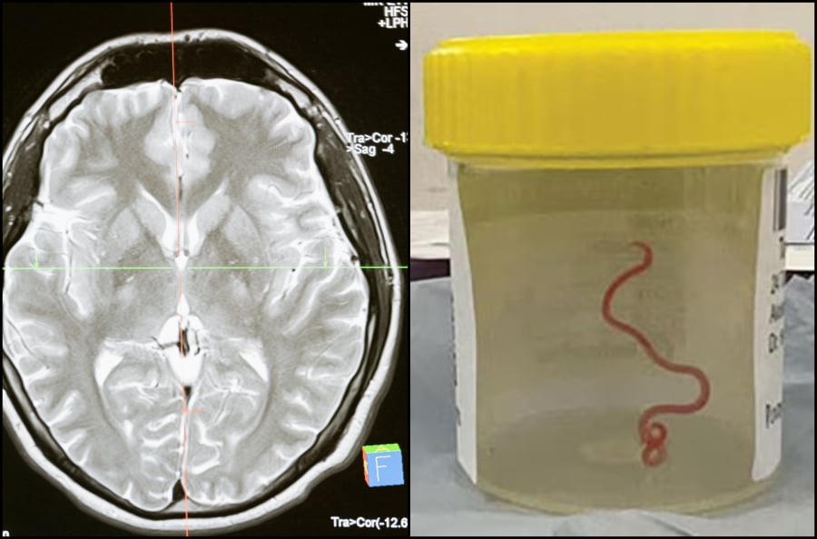 «Δεν θα πιστέψετε τι βρήκα στην ασθενή... κουνιέται»: Πώς βρέθηκε στον εγκέφαλο γυναίκας ζωντανό σκουλήκι